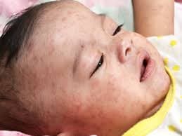 Se propaga por Europa la epidemia de sarampión.