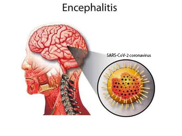 Indicios de que el coronavirus puede afectar al sistema nervioso