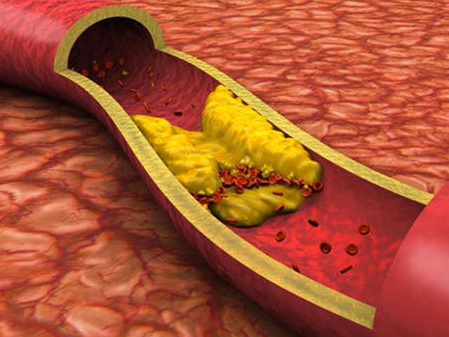Los coágulos sanguíneos: cinco factores de riesgo