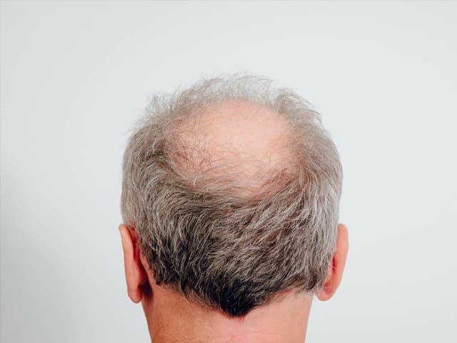 Podrían encontrarle solución a la calvicie