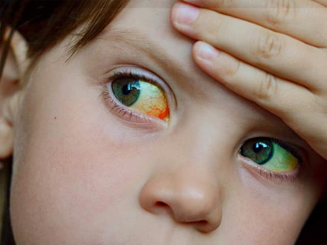La nueva hepatitis infantil podría vincularse con Covid-19