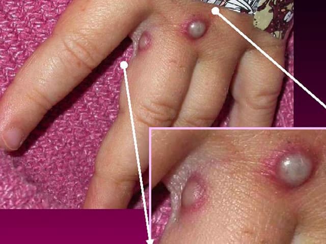 Para entender qué es la viruela  del mono y cómo hay que actuar